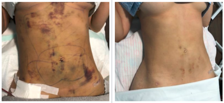 Full-body lymphatic drainage massage at iOnyx Medspa Merritt Island for detox, inflammation reduction, and recovery