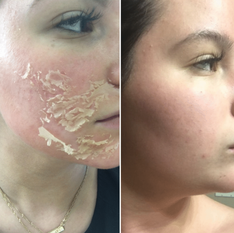 TCA Radiance Peel facial treatment for skin renewal at iOnyx Medspa Merritt Island