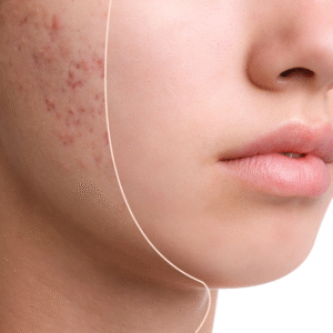 Acne Facial Treatment for Breakouts and Inflammation – iOnyx Medspa Merritt Island