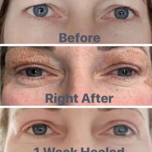 Fibroblast non-surgical facelift skin tightening treatment at iOnyx Medspa Merritt Island