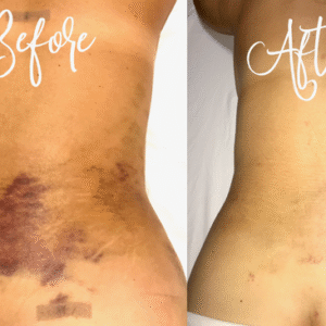 lymphatic drainage by iOnyx Medspa and Wellness Club