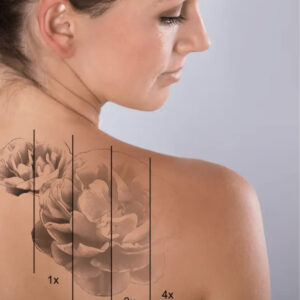 Tattoo Removal