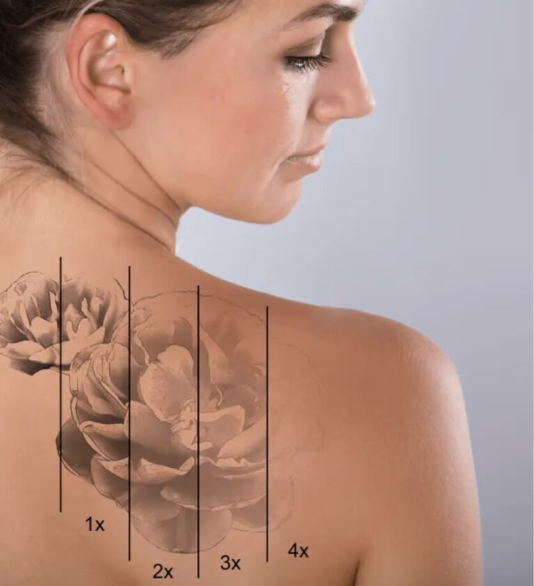 Tattoo Removal