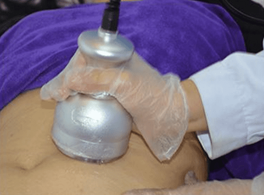 Cavitation body sculpting treatment for fat loss and post-surgery recovery at iOnyx Medspa Merritt Island