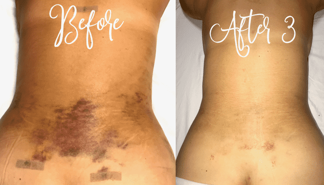 lymphatic drainage by iOnyx Medspa and Wellness Club